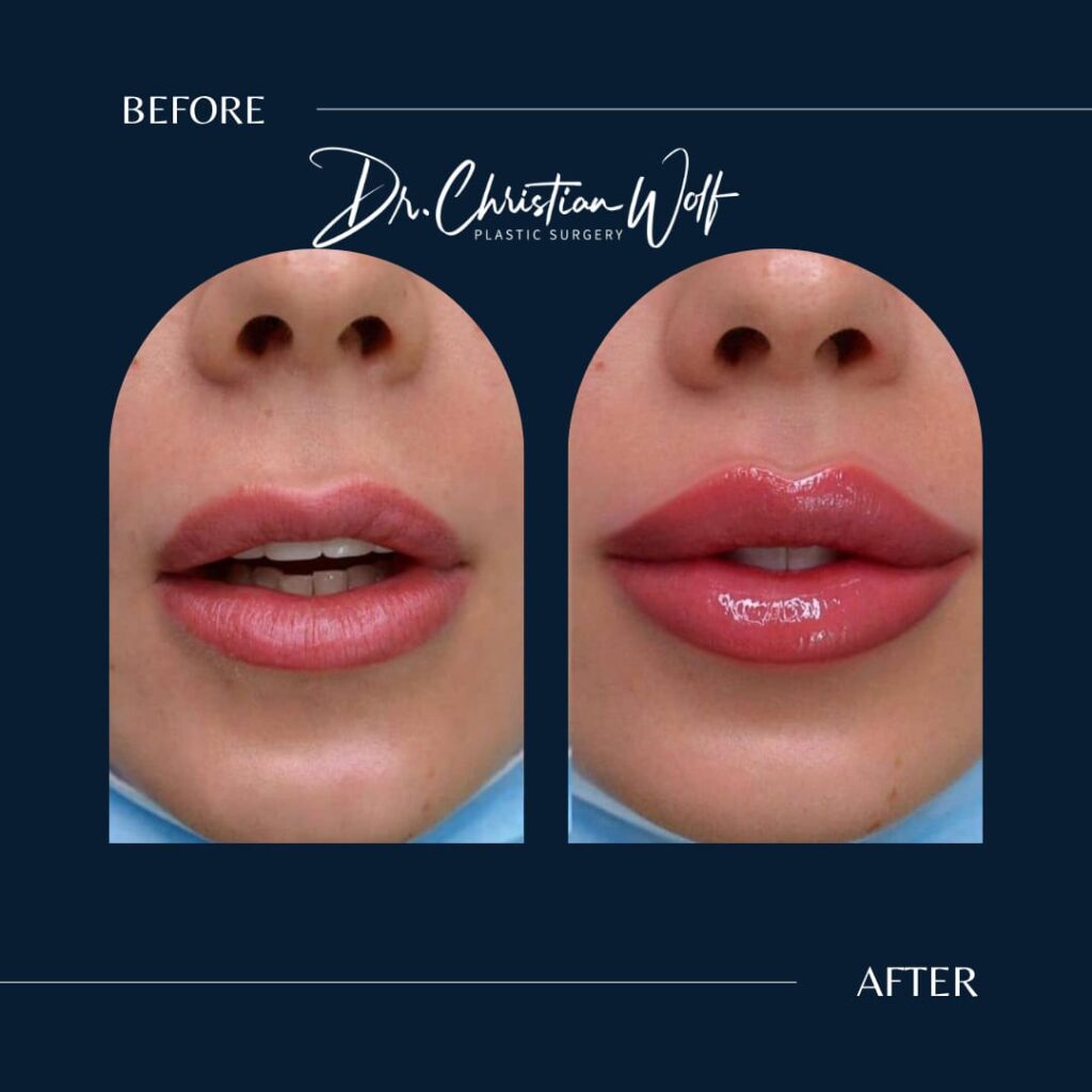 Lippen aufspritzen vorher/nachher bei Dr. Wolf 3